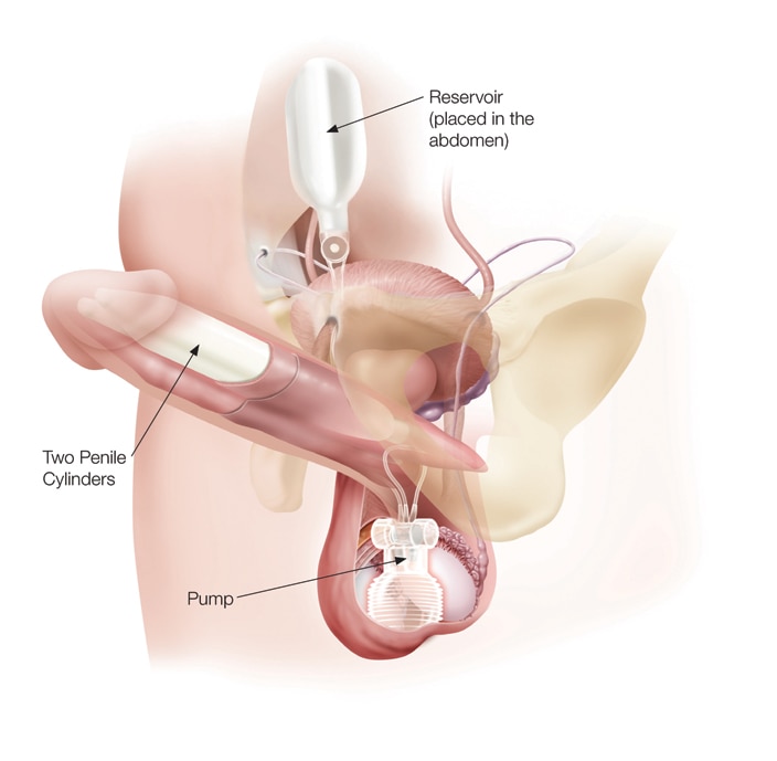 Penis implantat